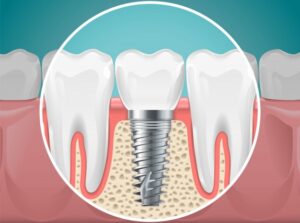 Mitos sobre los implantes dentales