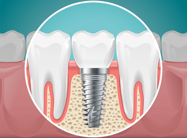 Mitos sobre los implantes dentales